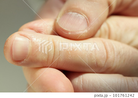 Patient shows eczema on fingers caring about skin health Patient shows eczema on fingers caring about skin health 101761242