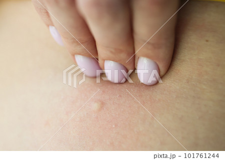 Female hand touches skin with rash examining eczema 101761244