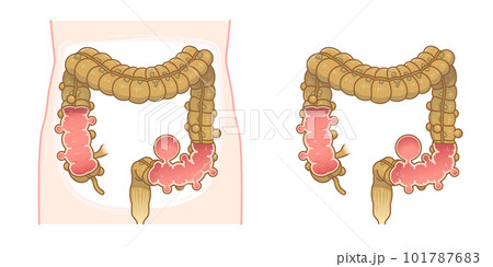 大腸憩室・憩室穿孔・憩室・Diverticulumのイラスト 101787683