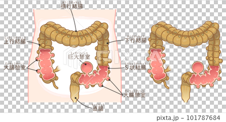 大腸憩室・憩室穿孔・憩室・Diverticulumのイラスト 101787684