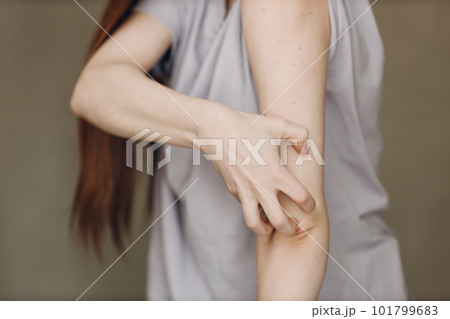Allergy dermatology scabies itches hand skin problem woman 101799683