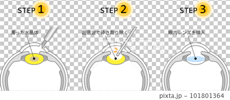 圖庫插圖: 說明白內障手術的流程（帶主線） 101801364