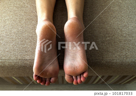 Dry cracked skin of woman feet in bed. Foot treatment. 101817033