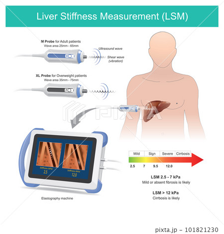 Liver Stiffness Measurement 101821230