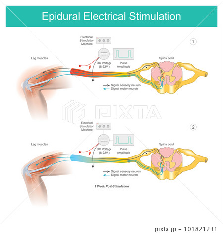 Epidural Electrical Stimulation. Muscle pain symptom in the leg area and treatment by electrical stimulation on skin and then passed the leg muscles and nerves. 101821231