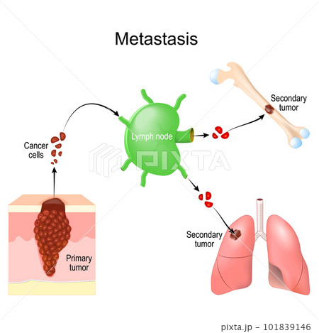 Metastasis. cancer invasion. malignant tumor. 101839146
