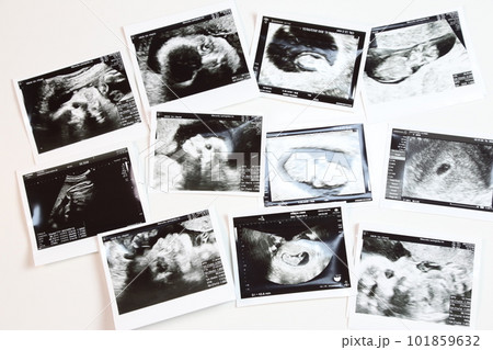 白いセラミックタイルの上に並べられた感熱紙のエコー写真 101859632