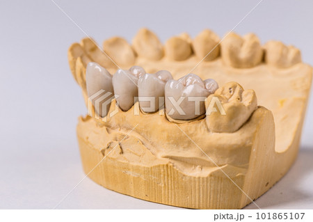 Dental prosthesis Dental prosthesis 101865107