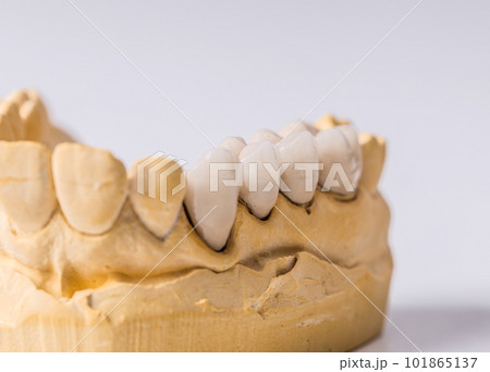 Dental prosthesis 101865137