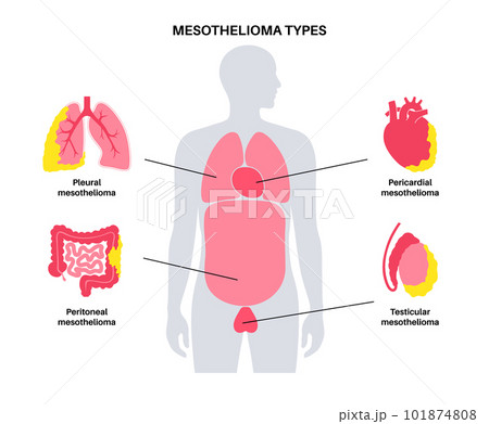 Mesothelioma tumor types 101874808