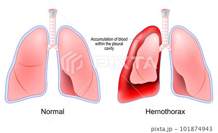 Hemothorax. Healthy human lungs and red lungs after accumulation of blood within the pleural cavity 101874943