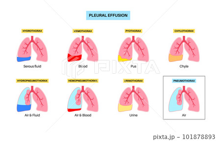 Pleural effusion poster Pleural effusion poster 101878893