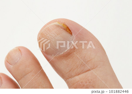 白背景の男の親指の爪の水虫 101882446