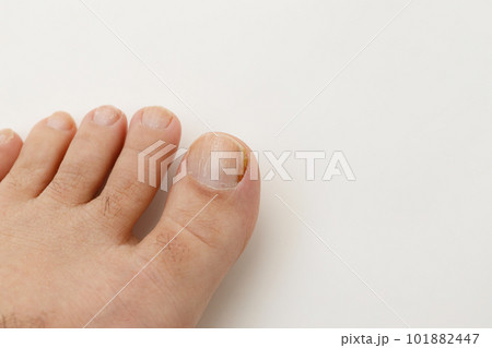 白背景の男の親指の爪の水虫 101882447
