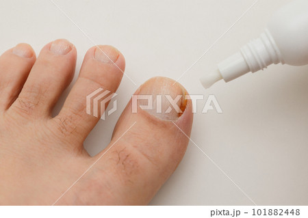 親指の爪の水虫治療 101882448