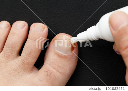 黒バックの爪の水虫治療 黒バックの爪の水虫治療 101882451