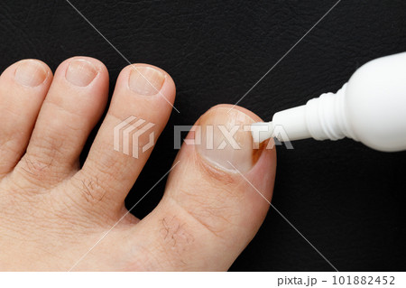 黒バックの爪の水虫治療 黒バックの爪の水虫治療 101882452