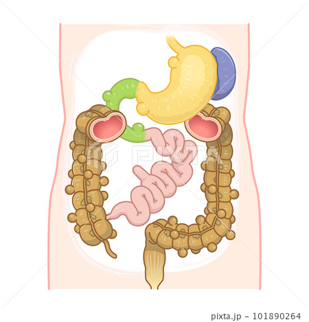 大腸憩室・憩室穿孔・憩室・Diverticulum・メッケル憩室・メッケル憩室癌のイラスト 大腸憩室・憩室穿孔・憩室・Diverticulum・メッケル憩室・メッケル憩室癌のイラスト 101890264