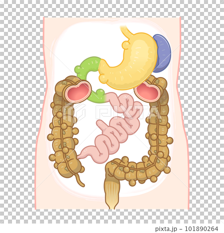 結腸憩室圖解 憩室穿孔 憩室 憩室 梅克爾憩室 梅克爾憩室癌 101890264