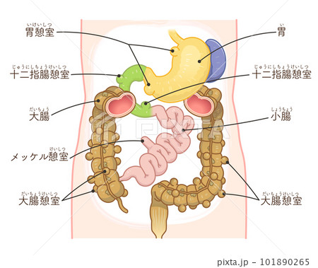 大腸憩室・憩室穿孔・憩室・Diverticulum・メッケル憩室・メッケル憩室癌のイラスト 101890265