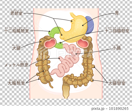 大腸憩室・憩室穿孔・憩室・Diverticulum・メッケル憩室・メッケル憩室癌のイラスト 101890265
