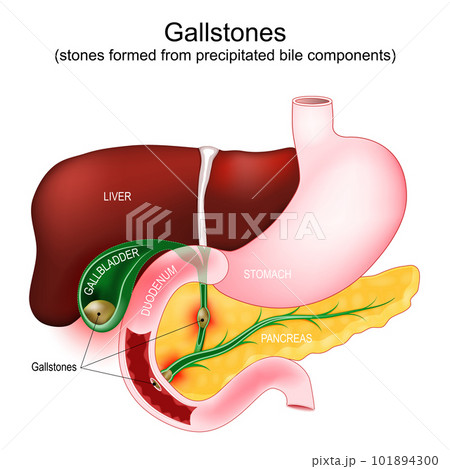 Gallstones. Parts of a digestive system: gallbladder, duodenum, stomach, liver, and pancreas. 101894300
