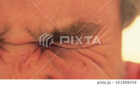 Man with bruised eye squints Man with bruised eye squints 101898456