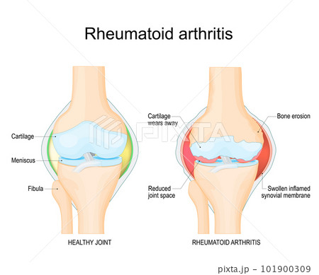 Rheumatoid arthritis.  101900309