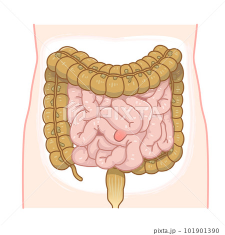 小腸のメッケル憩室・メッケル憩室癌・憩室穿孔・憩室のイラスト 小腸のメッケル憩室・メッケル憩室癌・憩室穿孔・憩室のイラスト 101901390