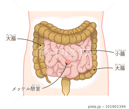 小腸のメッケル憩室・メッケル憩室癌・憩室穿孔・憩室のイラスト 小腸のメッケル憩室・メッケル憩室癌・憩室穿孔・憩室のイラスト 101901394