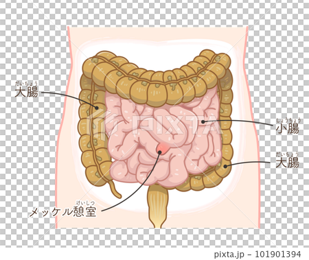 小腸のメッケル憩室・メッケル憩室癌・憩室穿孔・憩室のイラスト 小腸のメッケル憩室・メッケル憩室癌・憩室穿孔・憩室のイラスト 101901394