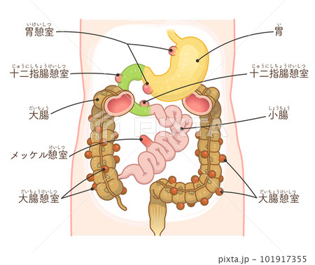 大腸憩室・憩室穿孔・憩室・Diverticulum・メッケル憩室・メッケル憩室癌のイラスト 101917355