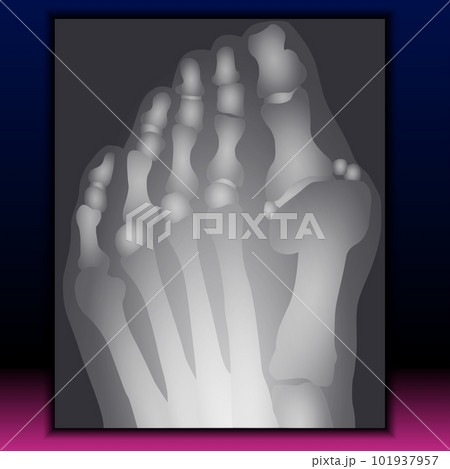 X-ray of Foot 101937957