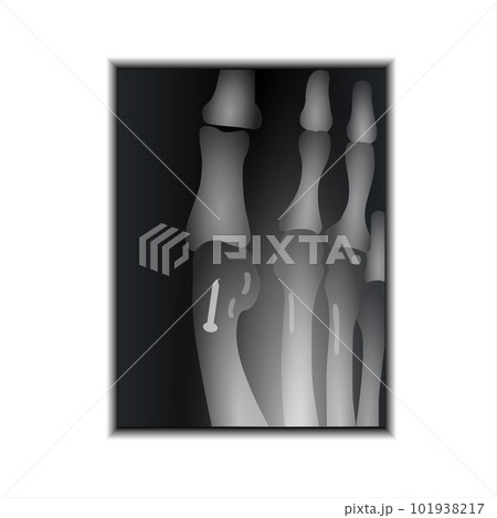 X-ray of Foot Claw 101938217