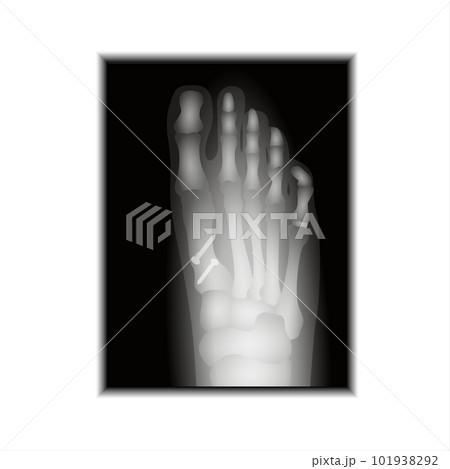 X-ray of Foot X-ray of Foot 101938292
