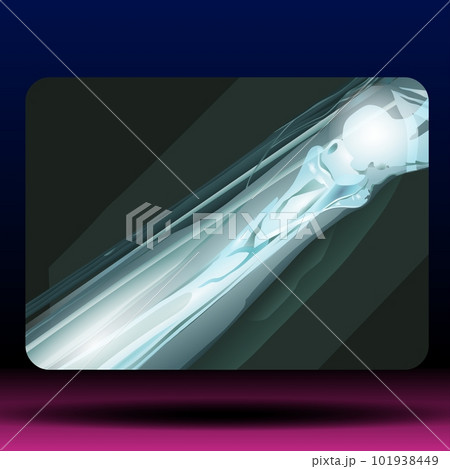 X-ray of Fracture Bone 101938449