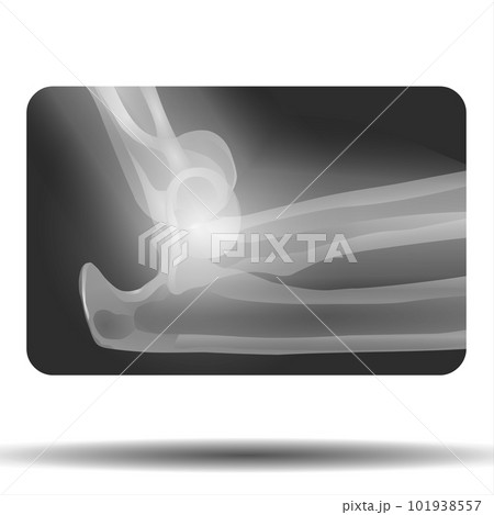 X-ray of Fracture Ankle Bone X-ray of Fracture Ankle Bone 101938557