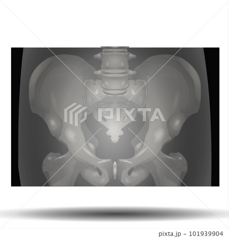 X-Ray of Pelvis 101939904
