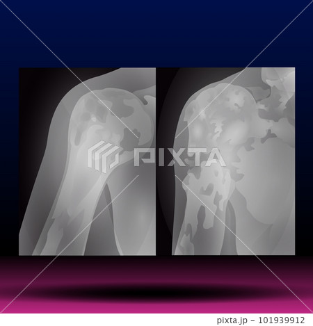 X-ray of Shoulder X-ray of Shoulder 101939912