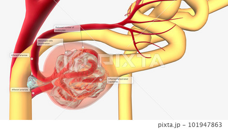 Glomerulonephritis is a group of renal conditions characterized by inflammation of the glomeruli within the kidney. Glomerulonephritis is a group of renal conditions characterized by inflammation of the glomeruli within the kidney. 101947863