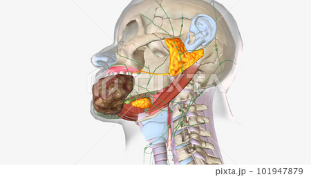 Stage four oral cancer is invasive and has spread beyond the tissue in which it first appeared. Stage four oral cancer is invasive and has spread beyond the tissue in which it first appeared. 101947879