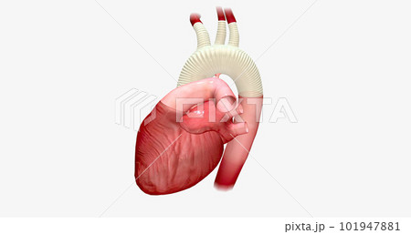 The enlarged portion of the aortic arch is replaced with a synthetic graft. 101947881