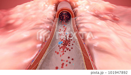 Blood clot begins to form, and is broken up by medication 101947892