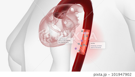 High volumes of lymphocytes, macrophages, and other immune cells infiltrate the inflamed aorta. 101947902