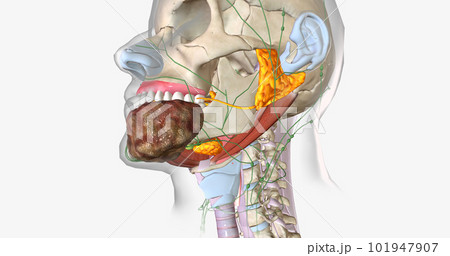 Stage four oral cancer is invasive and has spread beyond the tissue in which it first appeared. Stage four oral cancer is invasive and has spread beyond the tissue in which it first appeared. 101947907