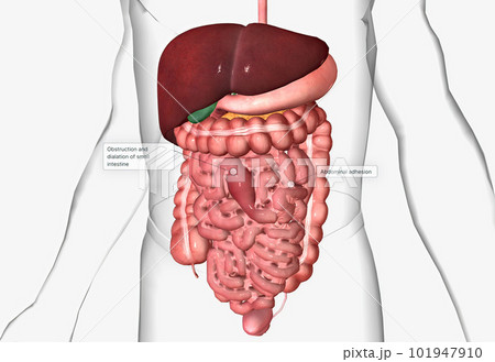 Abdominal adhesions, also called small intestine or GI adhesions Abdominal adhesions, also called small intestine or GI adhesions 101947910