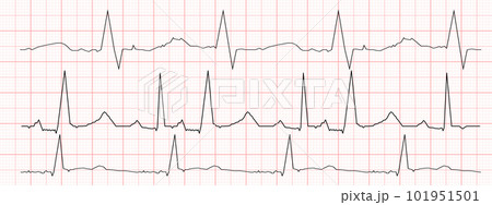 Set of black heartbeat diagrams on red graph...のイラスト素材 [101951501] - PIXTA