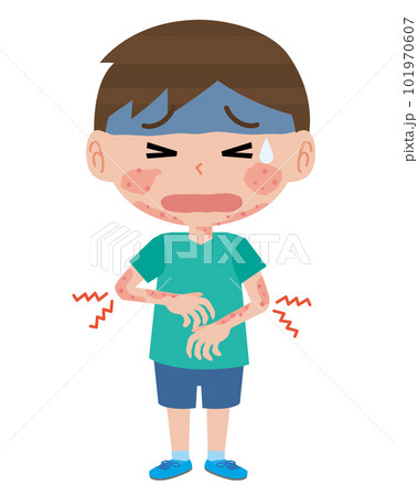 アトピー性皮膚炎の男の子 101970607
