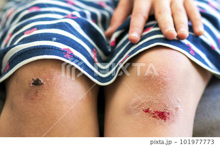 Close-up of little girl holding her bruised injured damaged knee with her hands Close-up of little girl holding her bruised injured damaged knee with her hands 101977773