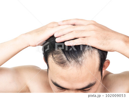 Closeup Young man serious hair loss problem with white backgroun for health care medical and shampoo product concept, selective focus 102009053
